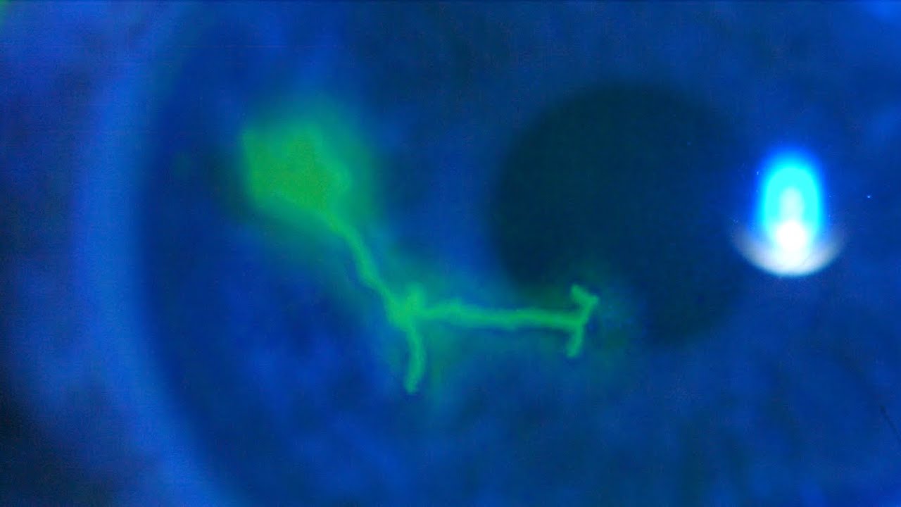 Clínica de las queratitis herpéticas dendrítica y geográfica