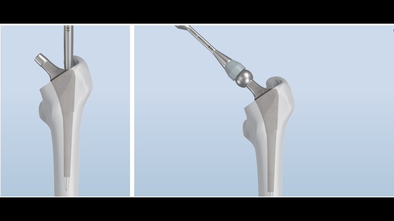 Double Medical PBG Cementless Hip Stem System
