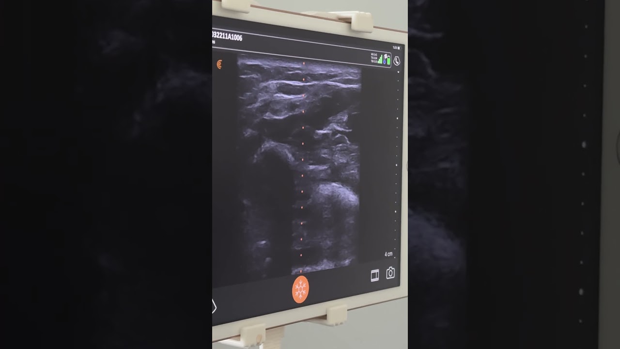 İnjection for Tremor via Bimodal Botox Technique (plexor pollicis longus muscle injection)
