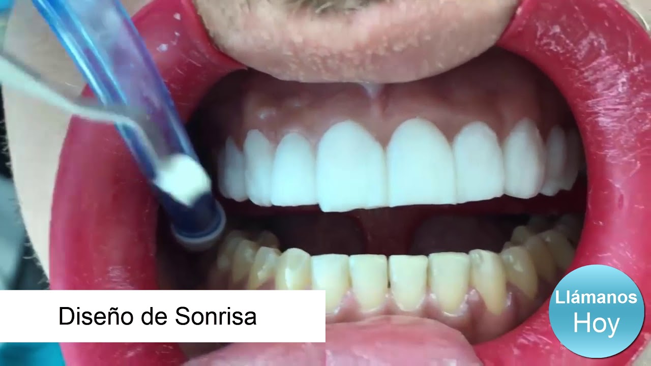 Diseno De Sonrisa en Guayaquil Ecuador