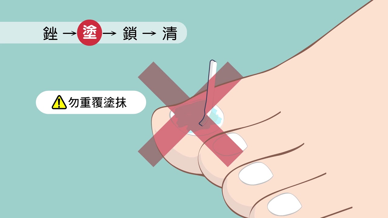 【衛教】灰趾甲用藥指導 (國語)