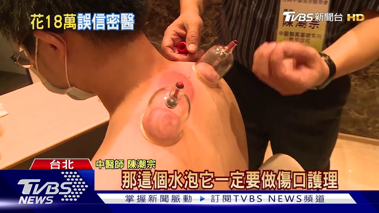 拔罐禁忌! 避開心臟.拔太久 憂起水泡感染