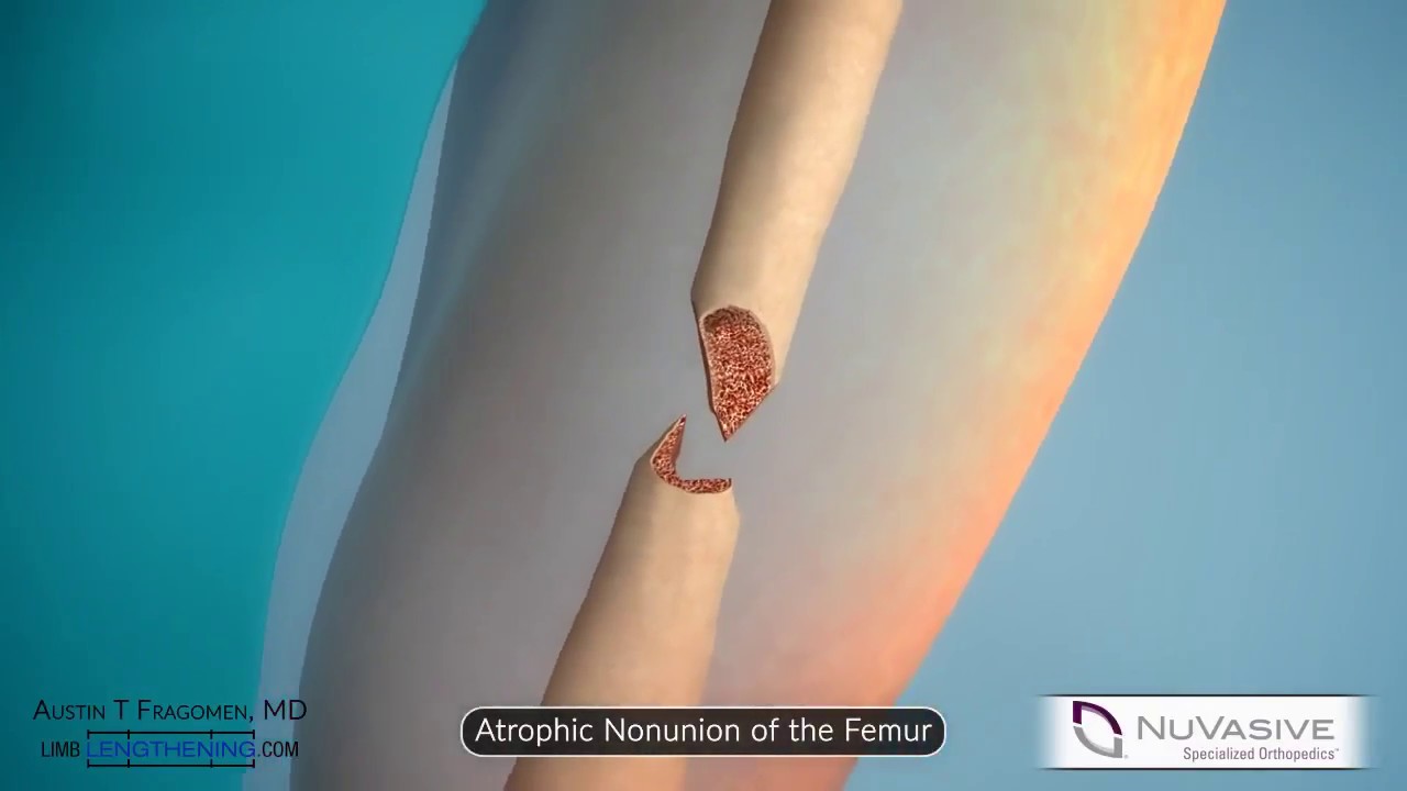Precice Nail for Compression of Nonunions