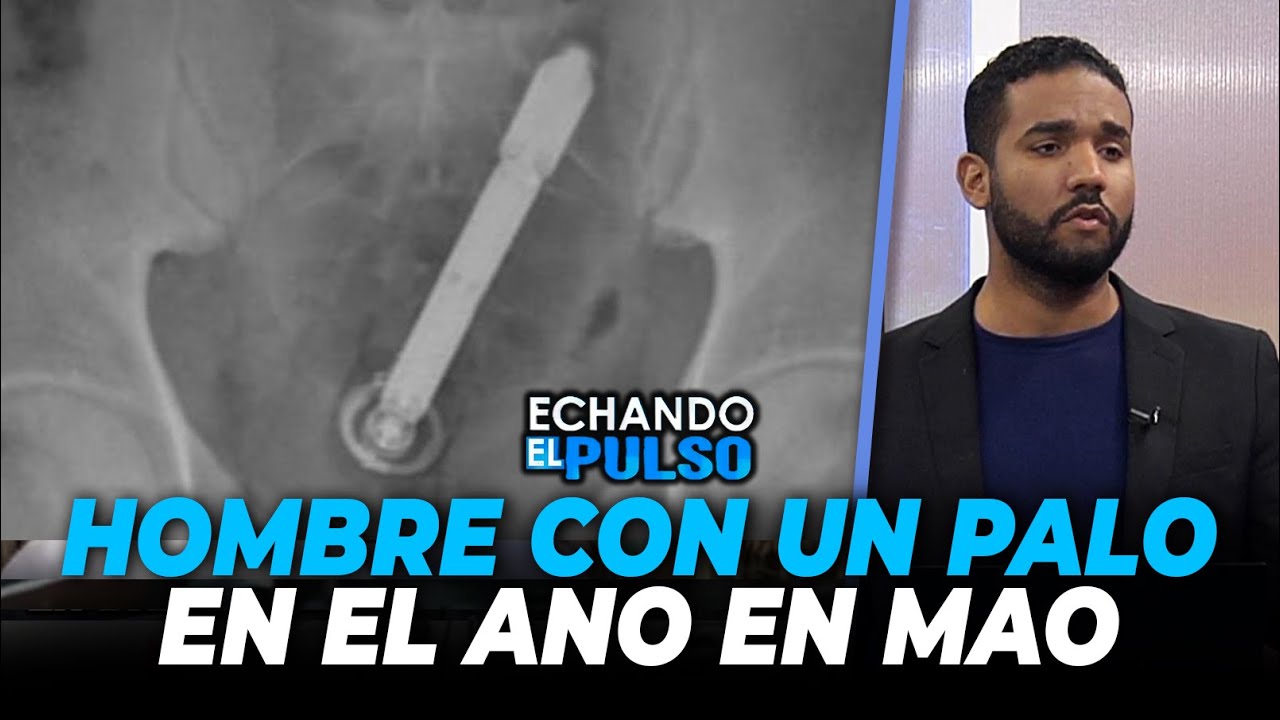 SantiContreras | ¡INSÓLITO EN MAO! Hombre llega hospital con palo en el ano | Echando El Pulso
