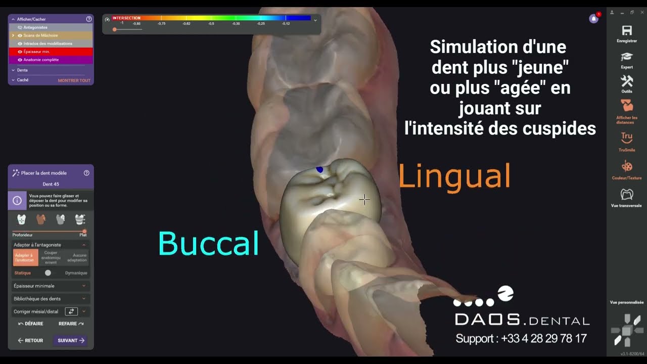 Nouveautés Exocad Rijeka 3.1 par Daos Dental