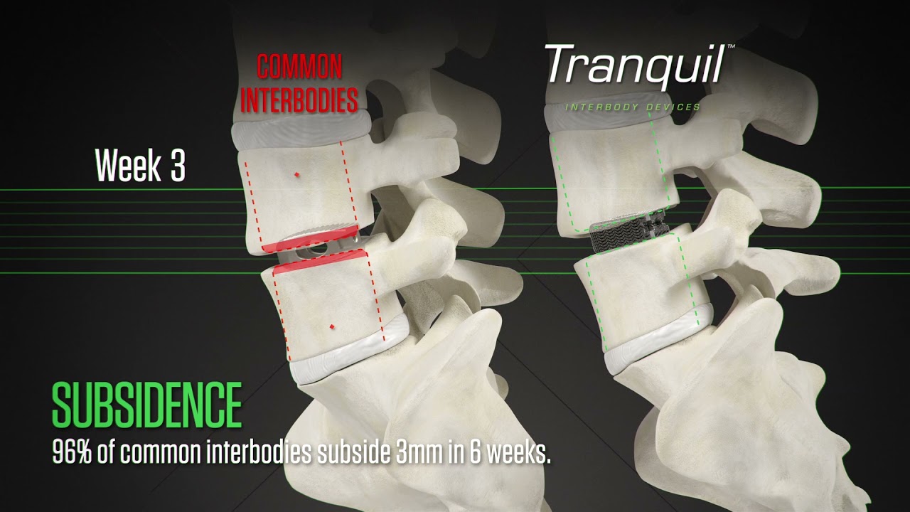 Nexus Spine Tranquil&trade;