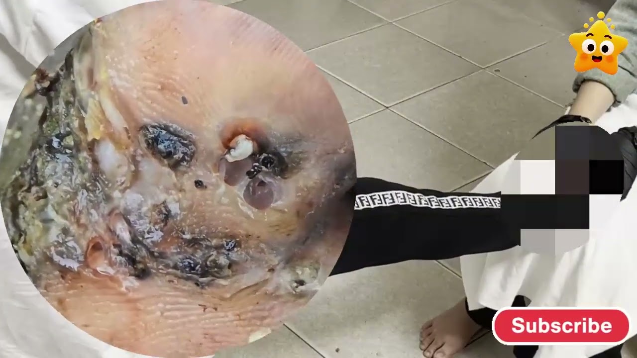 🚨 Massive Jigger Infestation – Dead Skin Ripped Off Clean! 