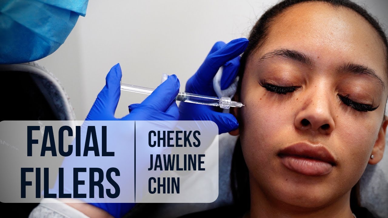 Cheeks, Jawline, and Chin Filler (Restylane Lyft) - Sabrina Pham, RN | West End Plastic Surgery