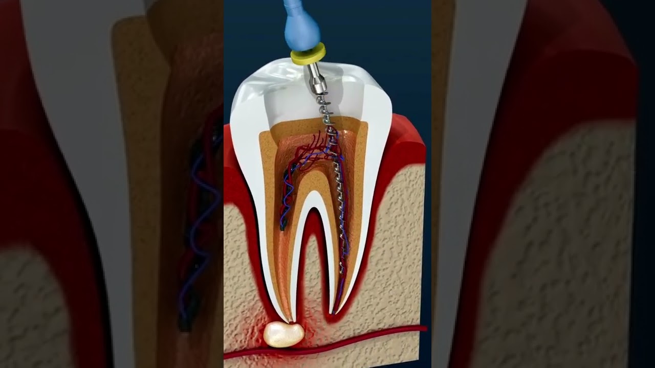 Una ENDODONCIA eficaz, supera la INFECCI&Oacute;N DENTAL