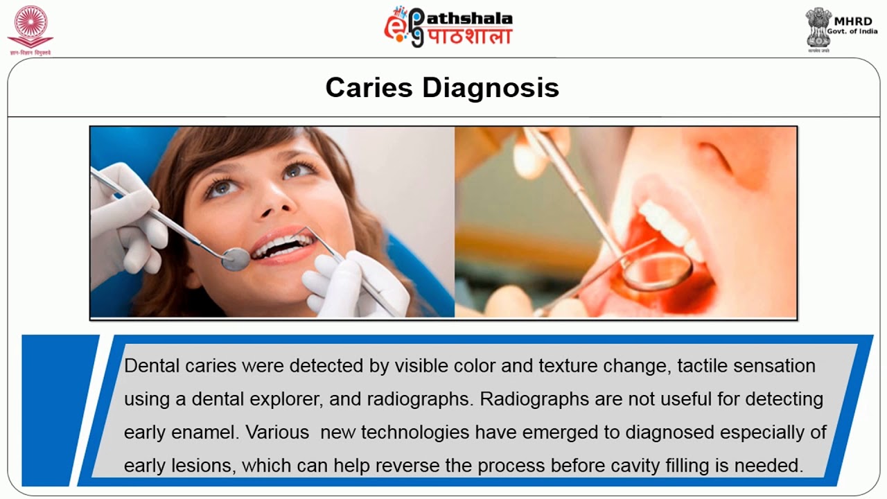 Preventive measures for Dental caries
