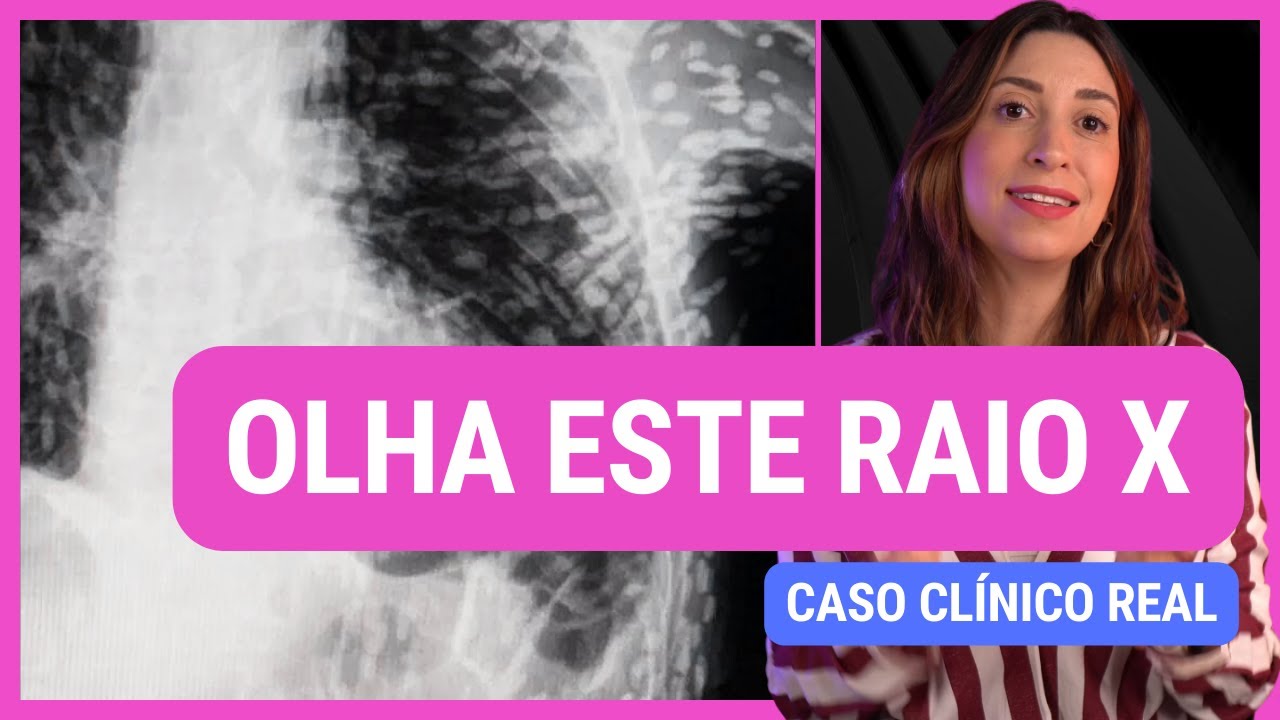 CASO CL&Iacute;NICO REAL: CISTICERCOSE! Anatomia etc. #cisticercose