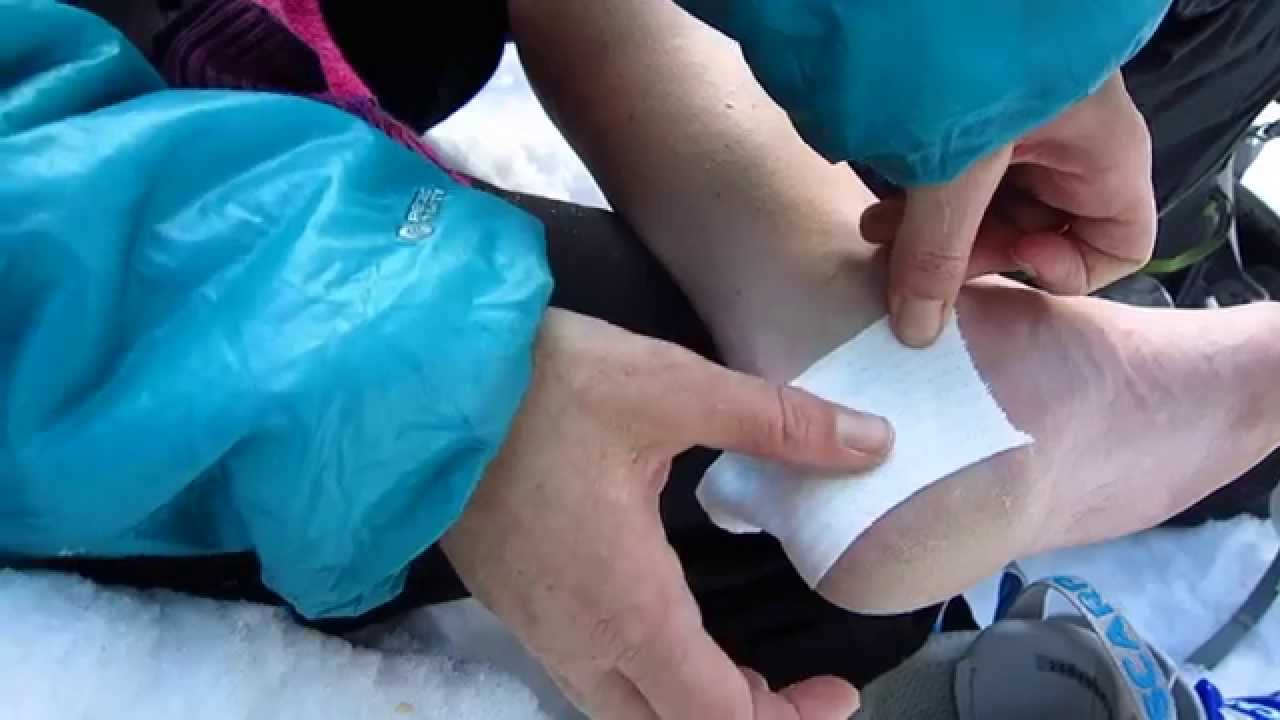 Blisters 101
