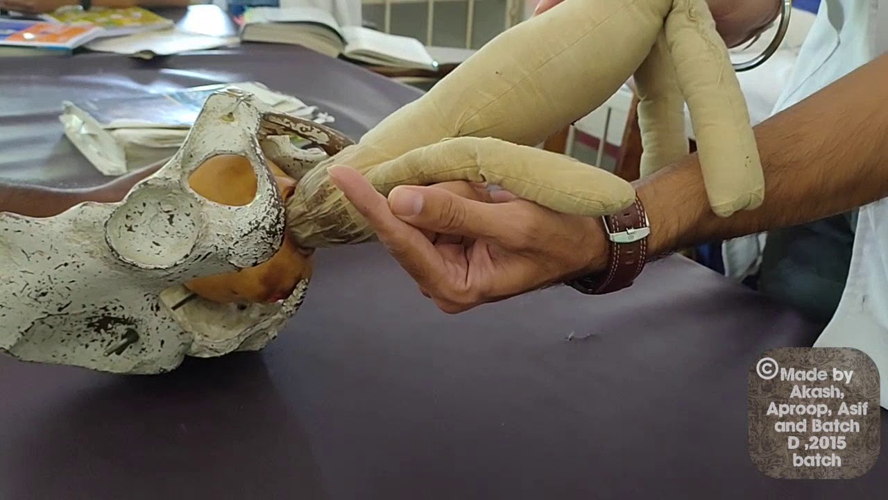 Assisted breech delivery | Burns Marshall method | mauriceau smellie veit technique |