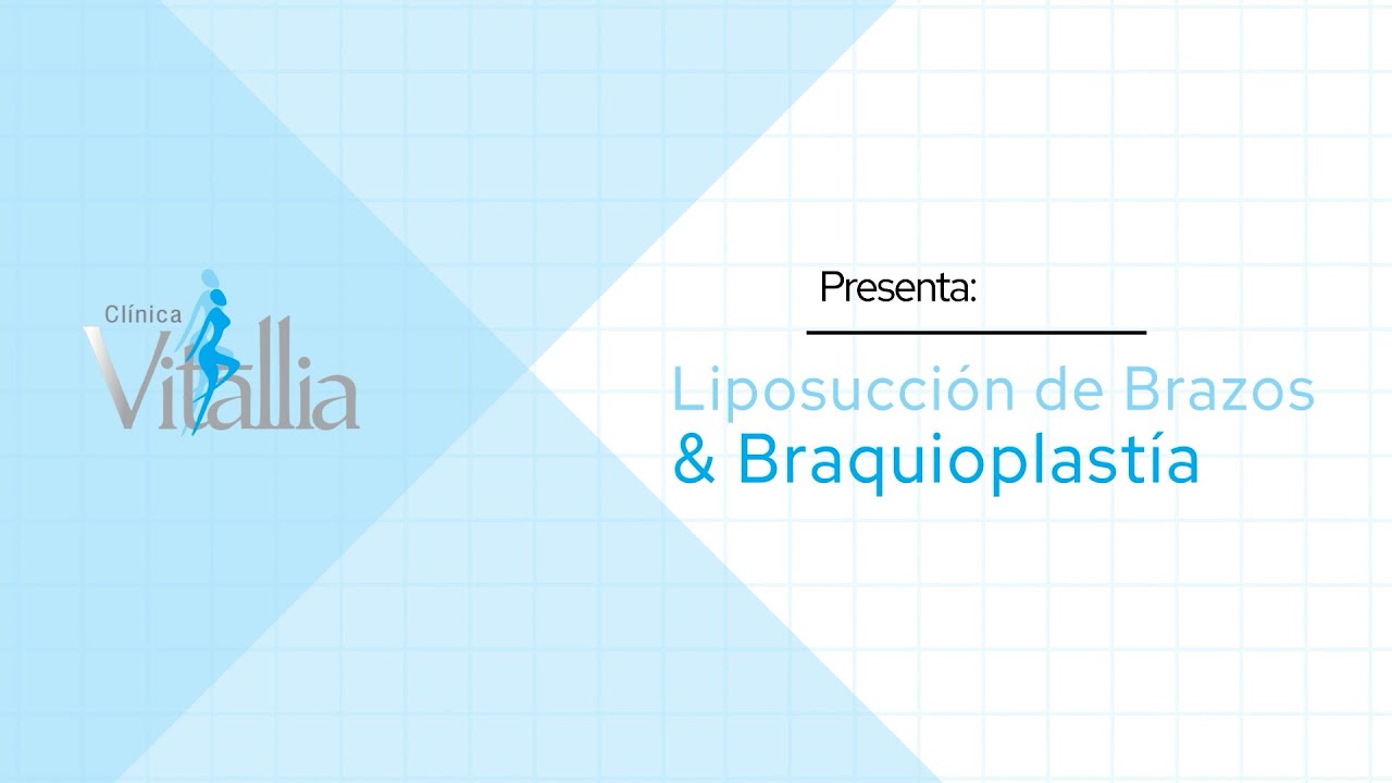 Liposucción de Brazos & Braquioplastía - Técnicas y preguntas frecuentes