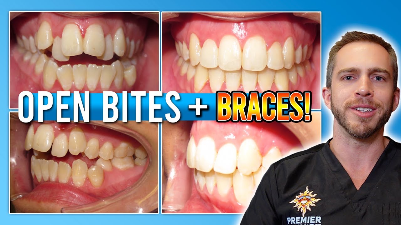 Open Bite Braces Treatment [BEFORE & AFTER!]