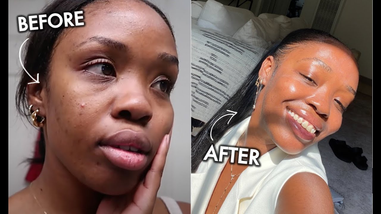 HOW I CLEARED MY ACNE + HYPERPIGMENTATION! The BEST Skincare Products to Get Rid of Breakouts!