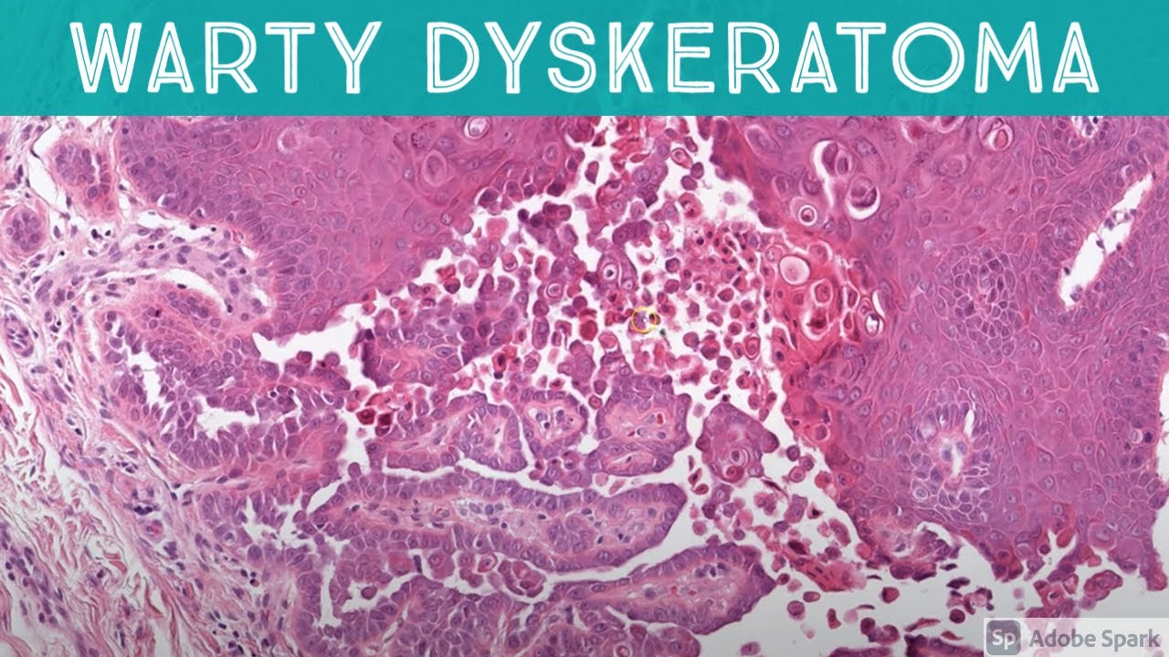 Warty Dyskeratoma (acantholytic dyskeratosis pattern)(dermatology pathology dermatopathology)