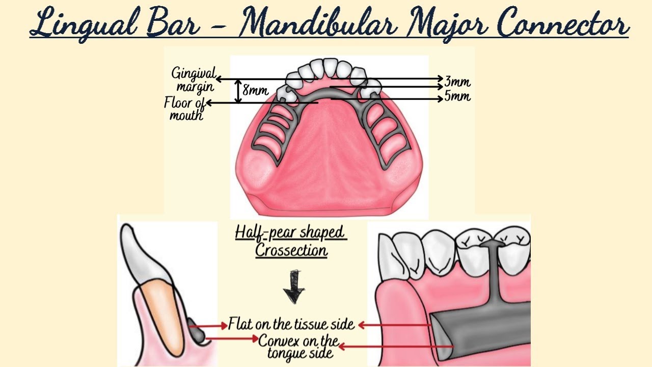 Lingual Bar - Mandibular Major Connector/ Removable Partial Dentures