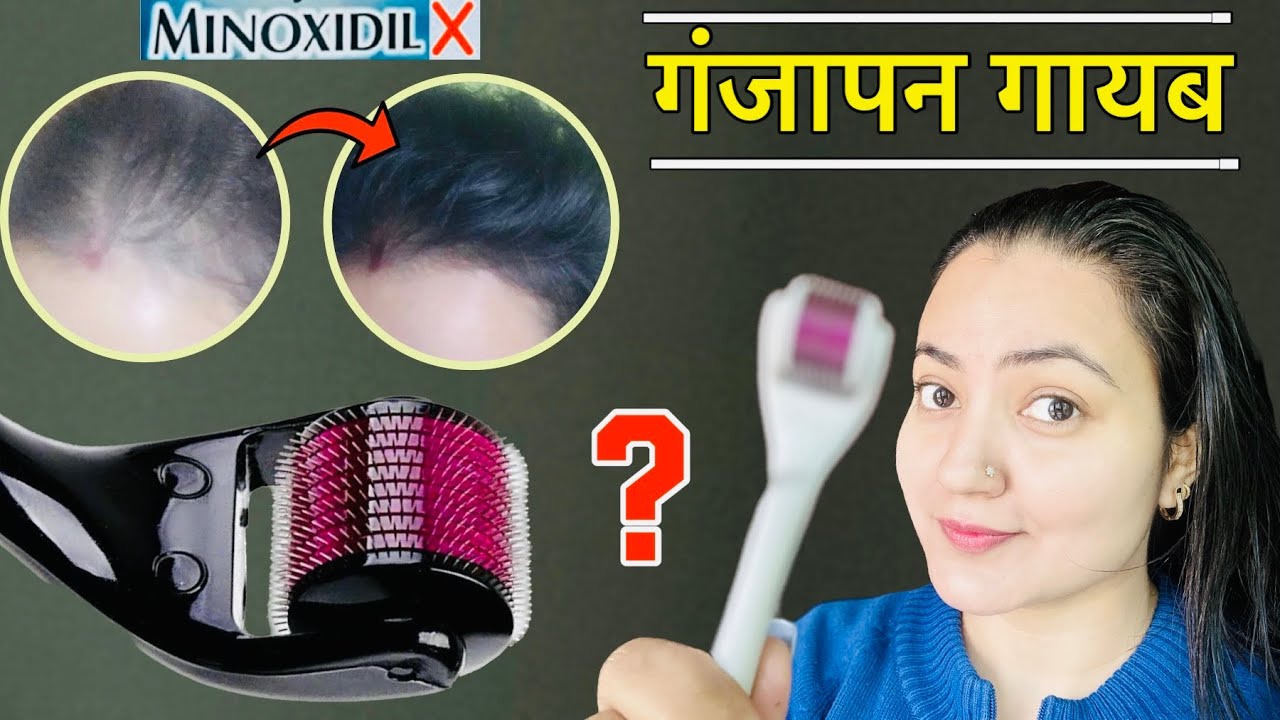 1 महीने में *Derma Roller* से बालों को REGROW करने का BEST तरीका जो कोई नहीं बताएगा | 100% Result❤️