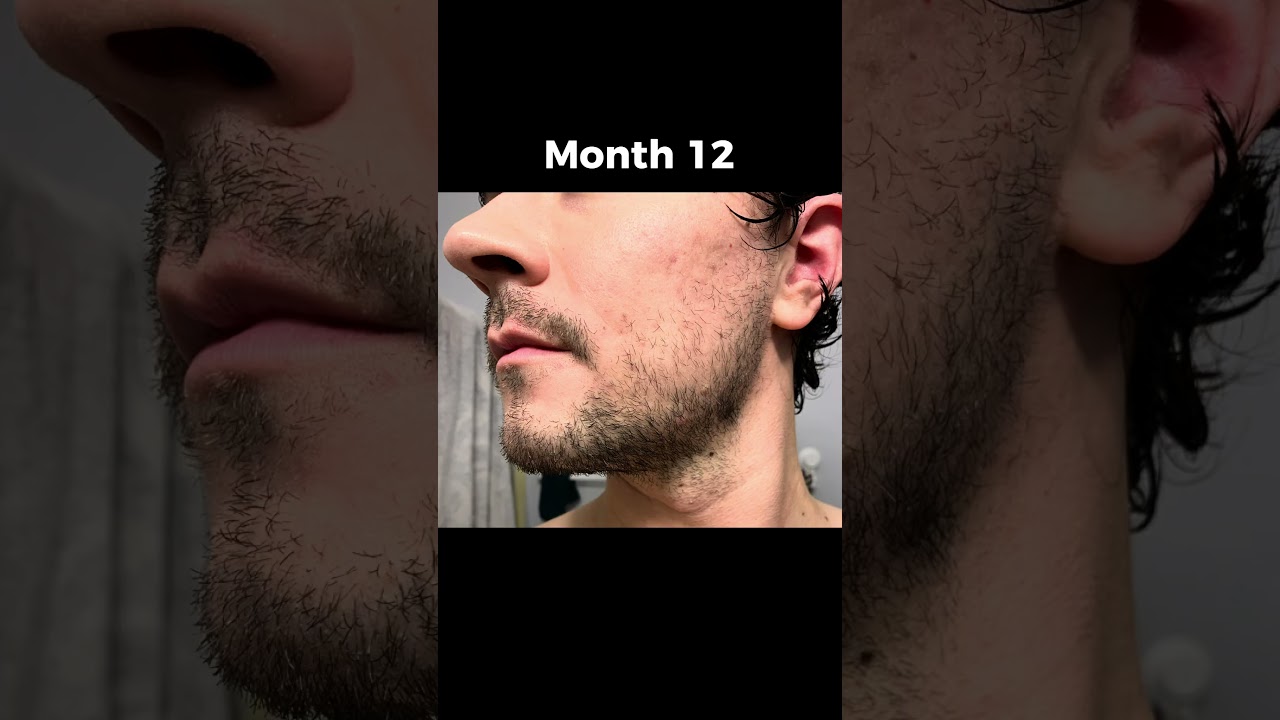 My Beard Growth Journey on Minoxidil #hairgrowth #beardgrowth #minoxidil