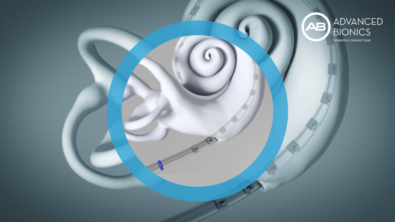 Comment est ins&eacute;r&eacute; l'&eacute;lectrode dans la cochl&eacute;e ?