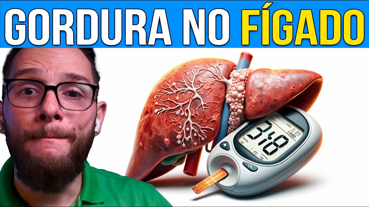 DIABETES TIPO 2 E GORDURA NO F&Iacute;GADO (esteatose hep&aacute;tica)