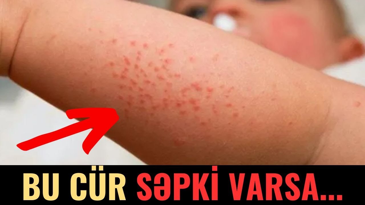 Uşaqlarınızda Bu Cür Səpkilər Varsa Bu Xəstəlikdən Xəbər Verir!