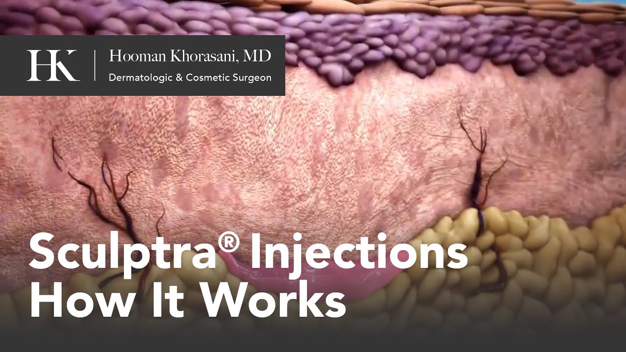 Sculptra&reg; Injections for Collagen Growth - How It Works | Offered by Dr. Hooman Khorasani