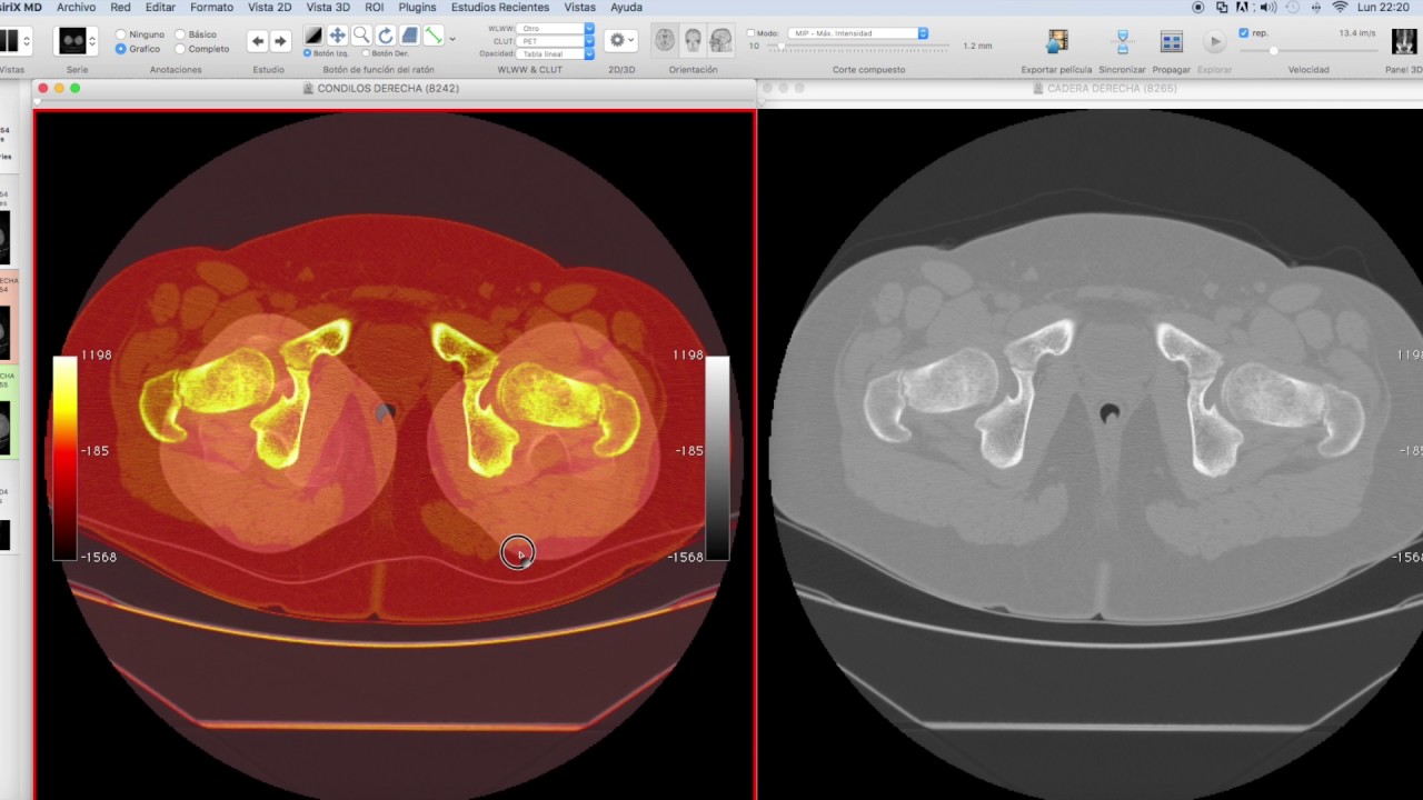 ANTEVERSION FEMORAL