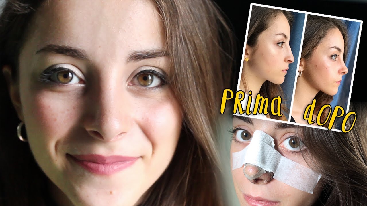 Vi racconto la mia SECONDA RINOSETTOPLASTICA 👃 | Qualcosa di Erre