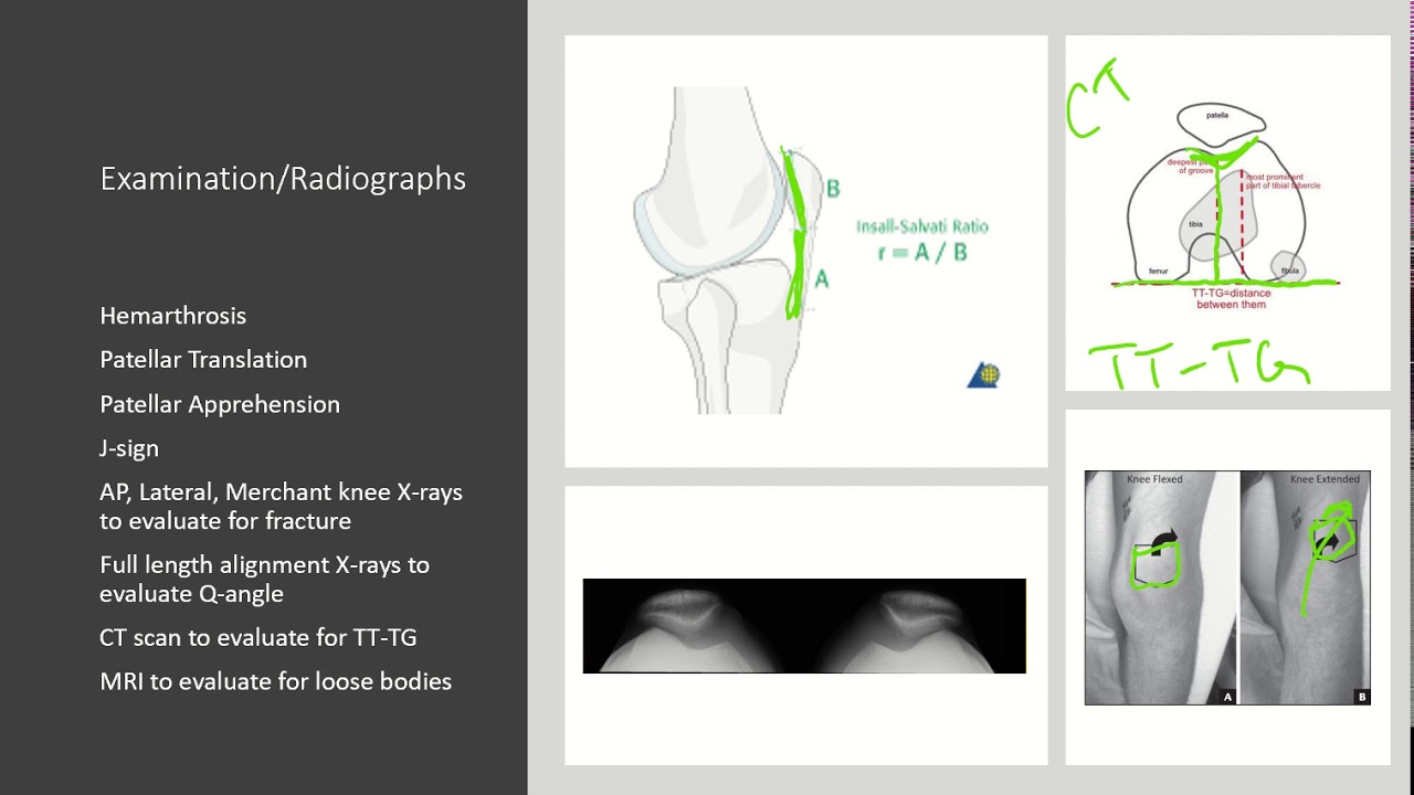 Patella Instability