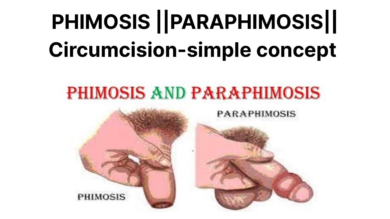 Phimosis and Paraphimosis- क्या होता है और क्या इलाज