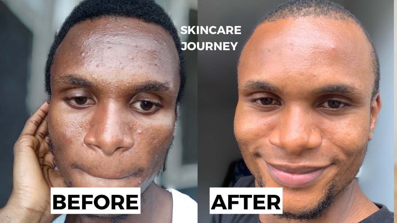 MY ACNE JOURNEY + Products i used in treating acne | will I recommend?