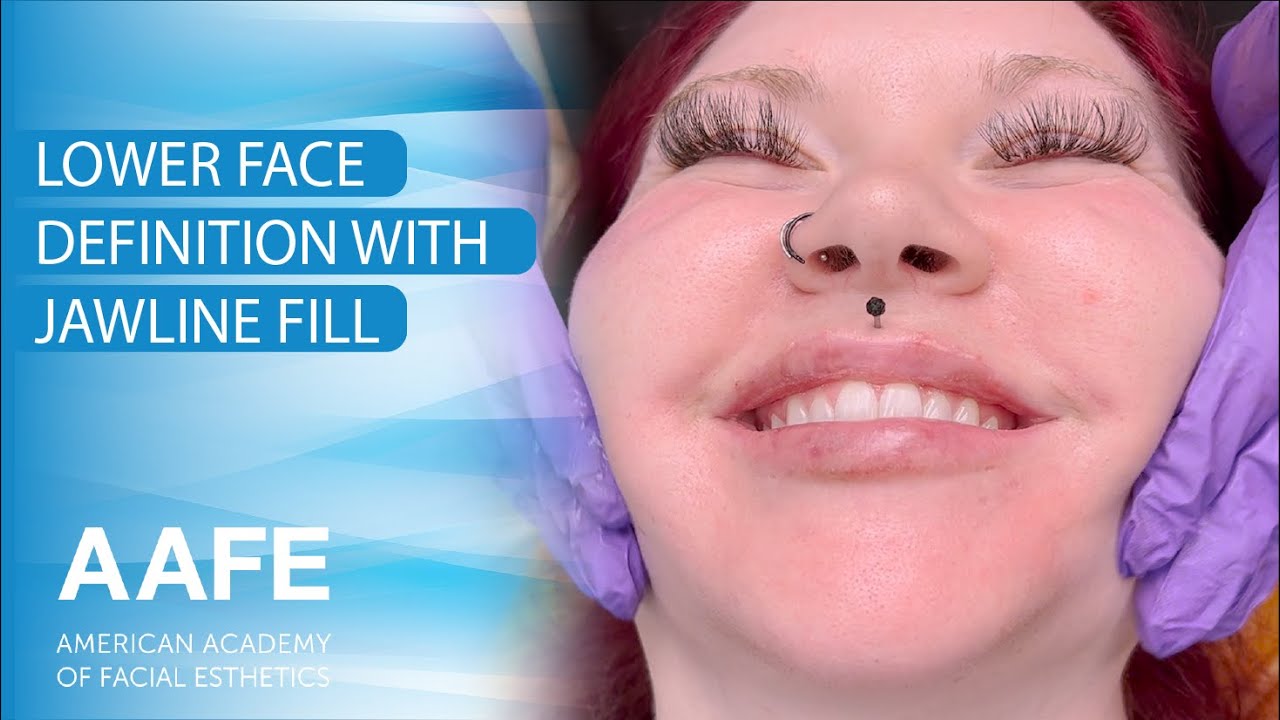 Lower Face Definition with Jawline Fill