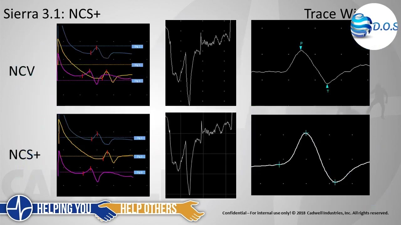 Cadwell  Sierra Summit EMG Presentation