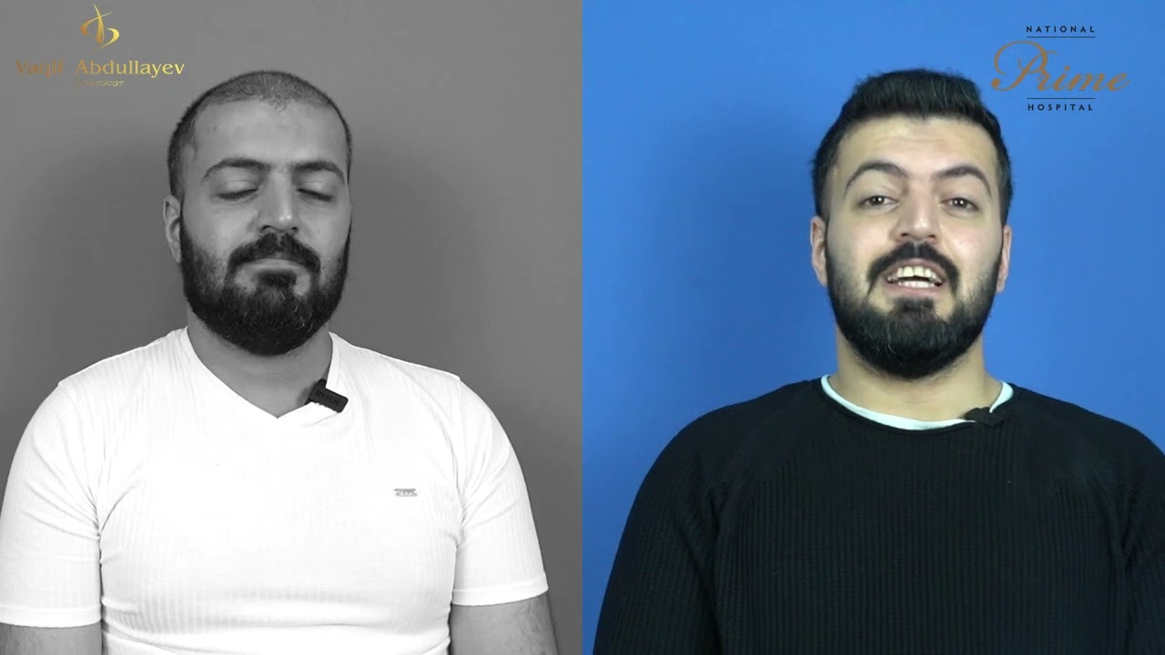 Saç Əkilən dən 8- aydan sonra