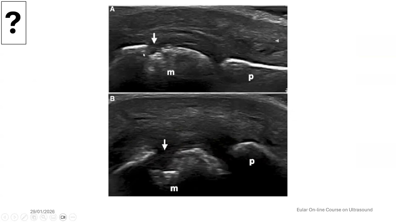 MSUS musculoskeletal ultrasound revision knee, elbow Dr Marwa Abo Elmaaty Besar, Mansoura University