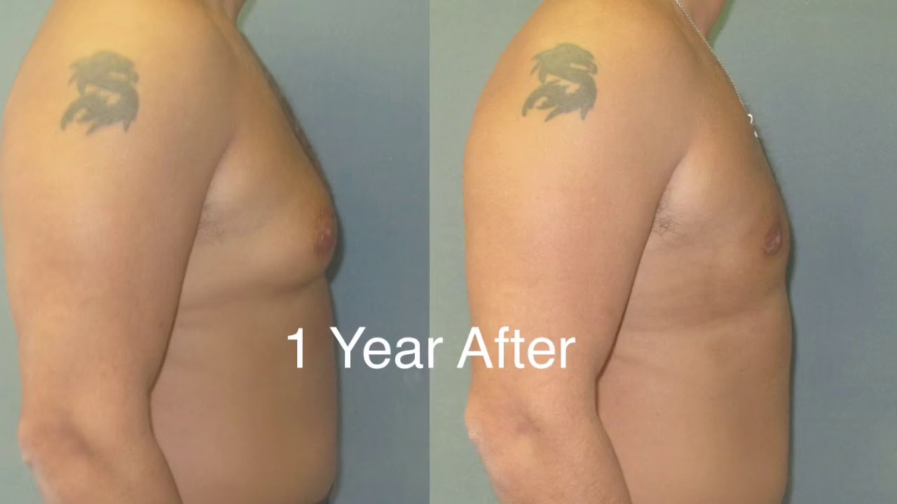 Gynecomastia surgery 1 year follow up results