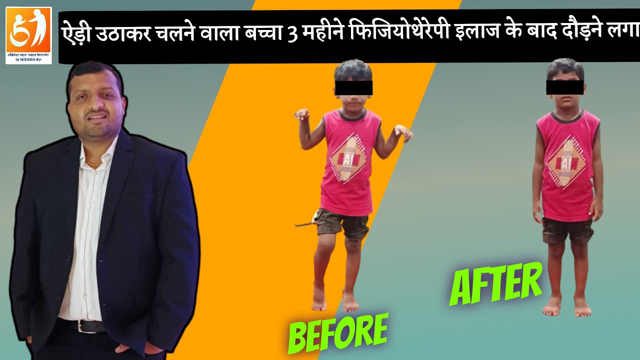 successful treatment of cerebral palsy child ! diplegia cerebral palsy  ! cerebral palsy child