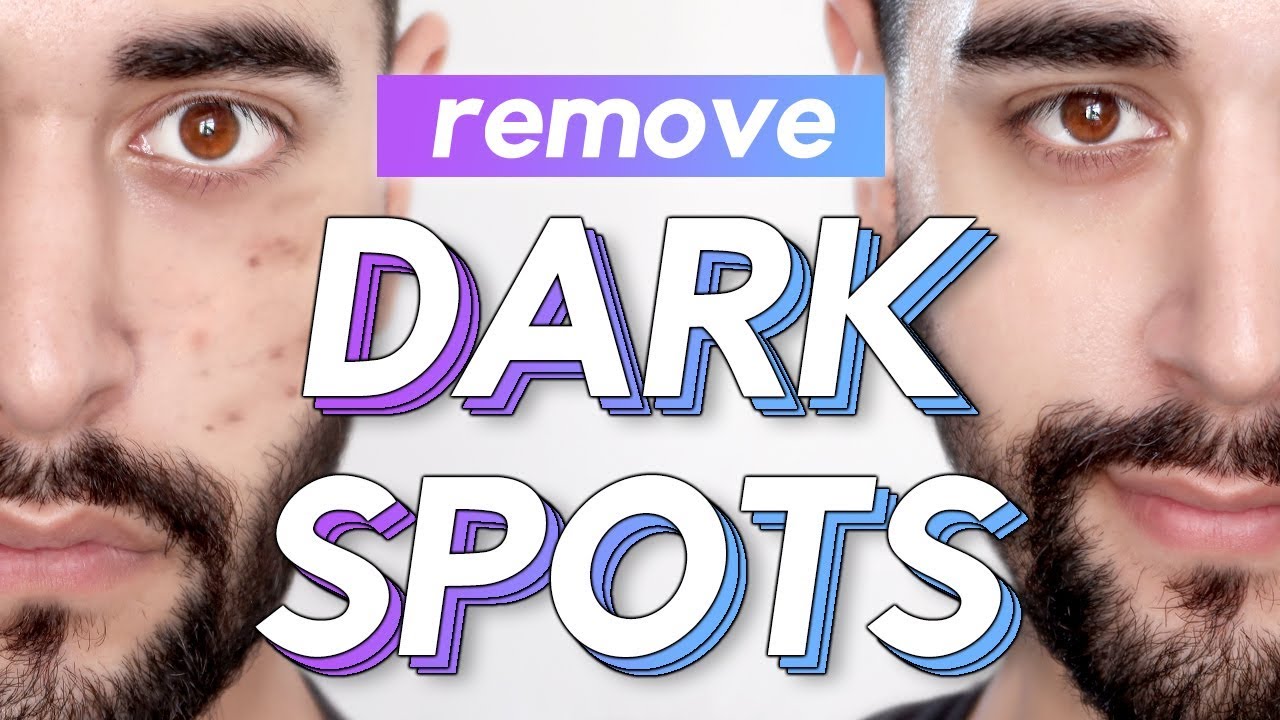 Remove Dark Spots / Acne Scars / Hyperpigmentation From The Face ✖ James Welsh