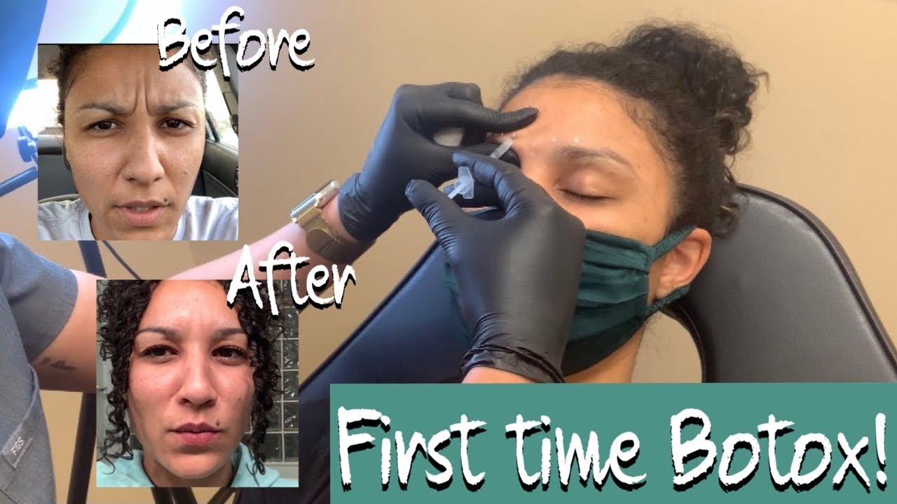 Getting Botox for the First Time for Glabella lines! (Eleven 11 lines)