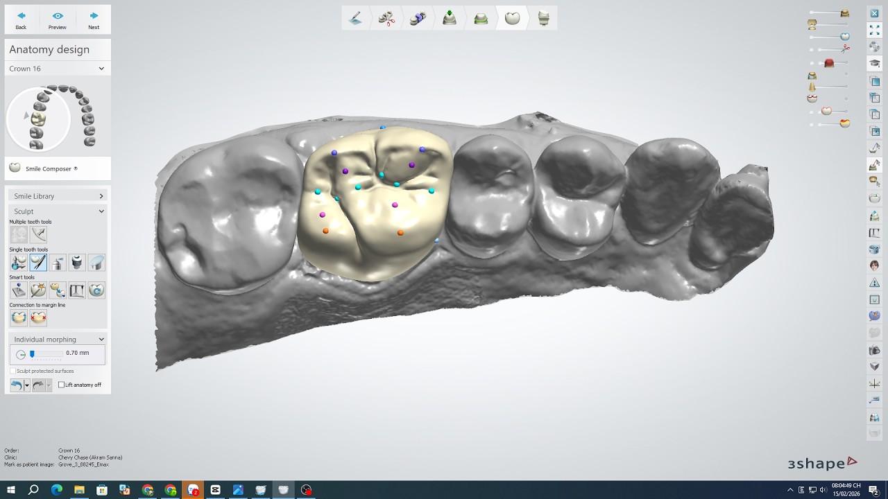 Designing a Crown in 3Shape