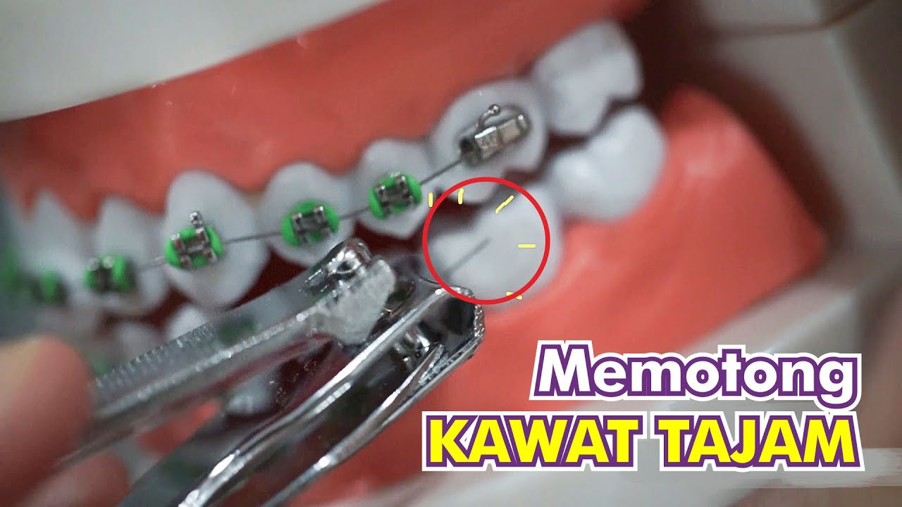 Tutorial Potong Kawat Gigi dan Memasukan Kawat yang Tajam - Hanya untuk keadaan EMERGENCY