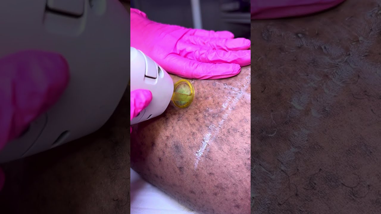 #laserhairremoval