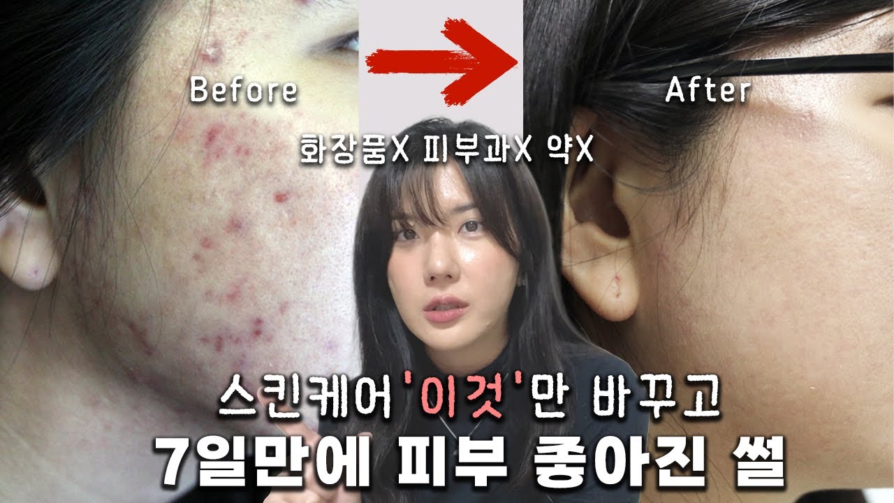광고❌ㅣ내 인생을 송두리째 바꾼 피부 관리 법ㅣ간증 영상ㅣ악건성 + 여드름 + 아토피 ‼️
