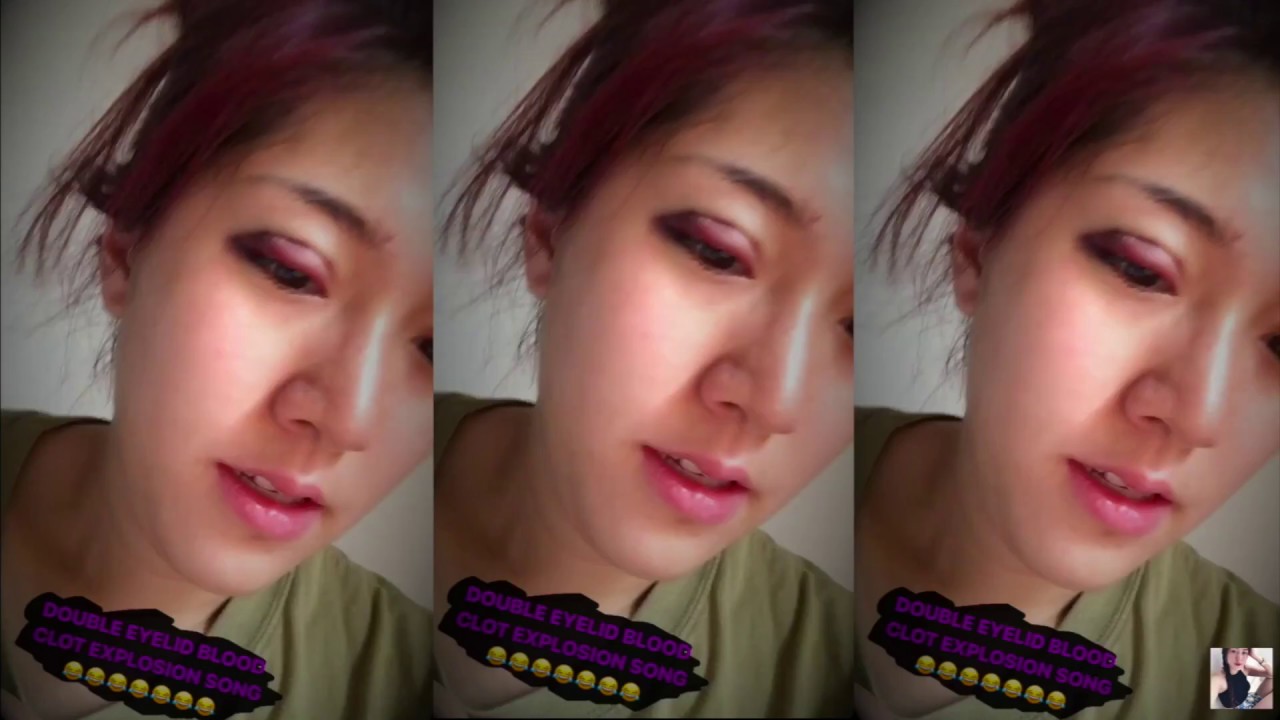Non-Invasive Double Eyelid Procedure Q&A || FATFOAL
