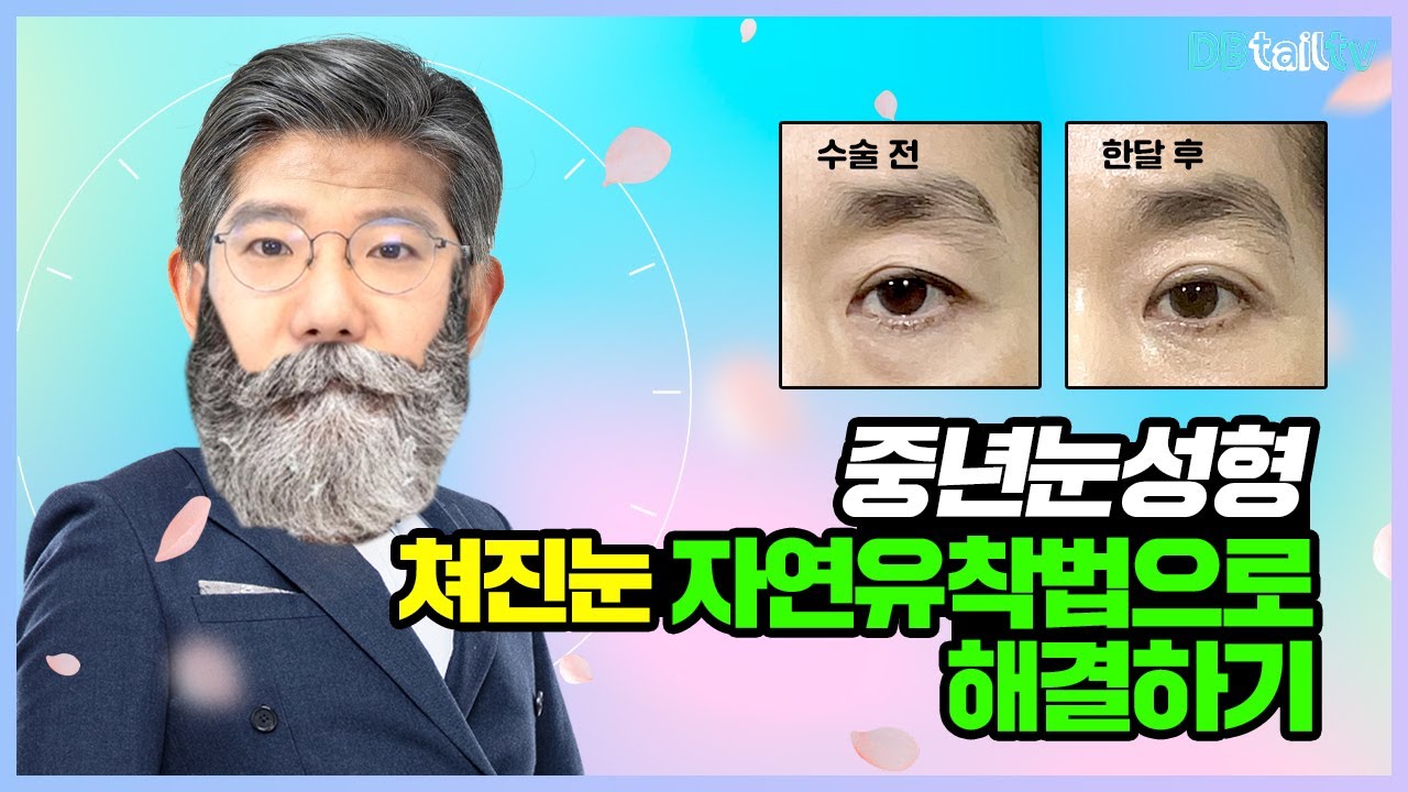 중년눈성형 처진눈 자연유착법으로 해결하기