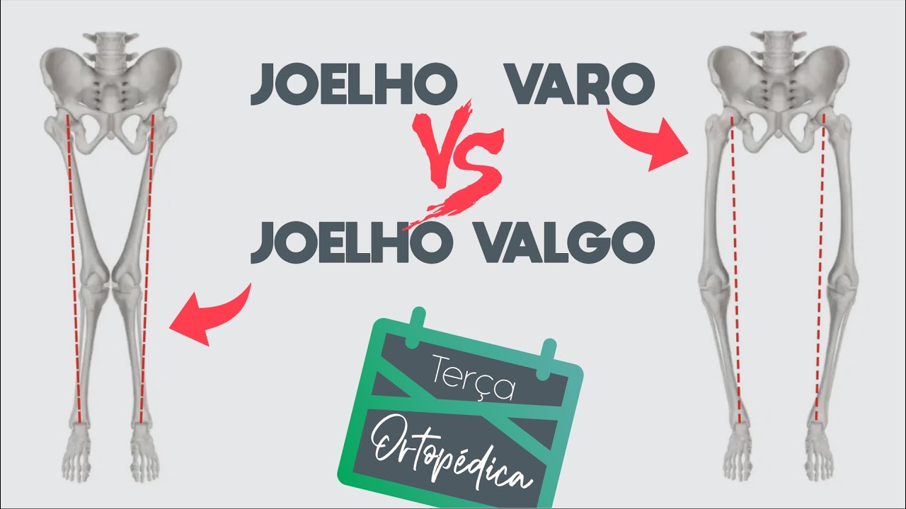 JOELHO VARO E JOELHO VALGO  (Dr. Eric Curi - part. Dr. Bruno Butturi)
