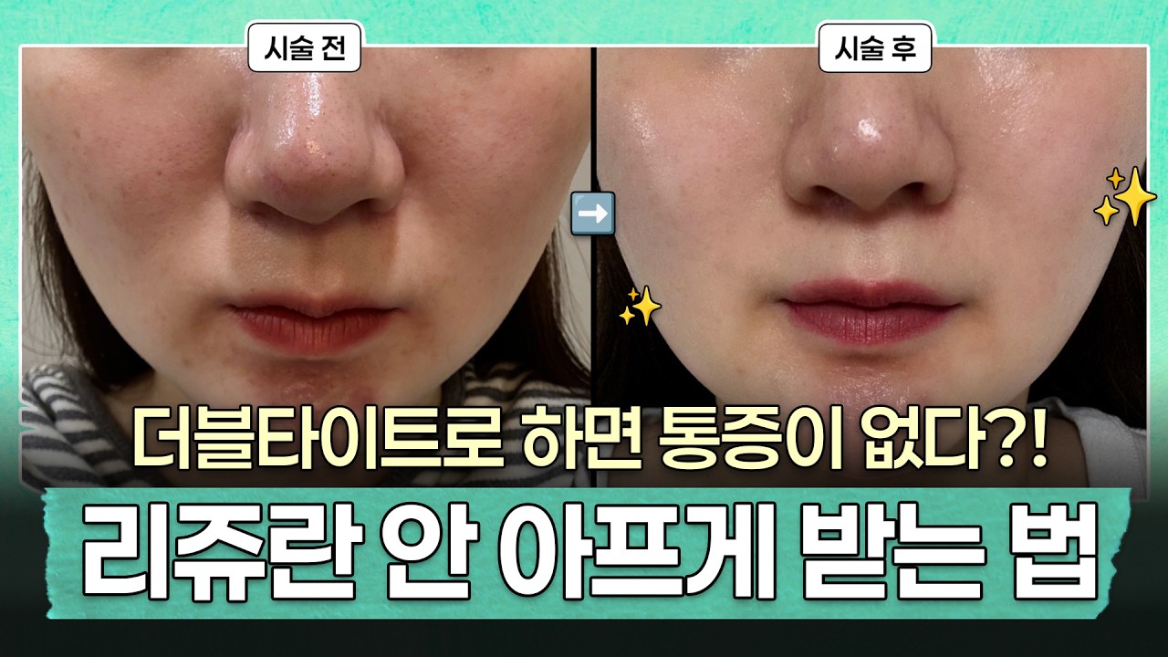 리쥬란 편안하게 받은 후기! 통증, 다운타임 없이 효과는 최대로?｜더블타이트로 받은 스킨부스터 실제 시술 전후까지
