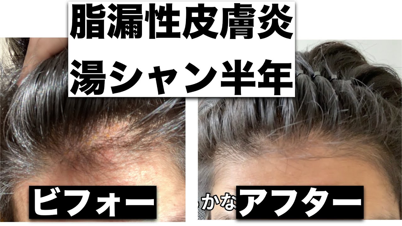 脂漏性皮膚炎シャンプー辞めて半年後のビフォーアフターがこちら